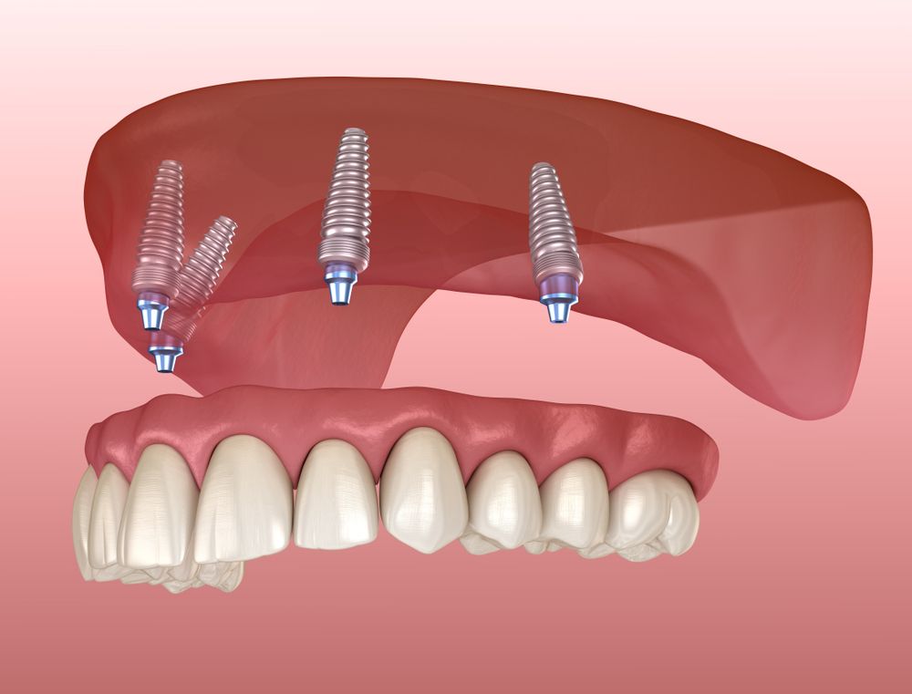A 3D illustration of different types of permanent implants used in cosmetic dentistry, such as crowns, bridges, and veneers.